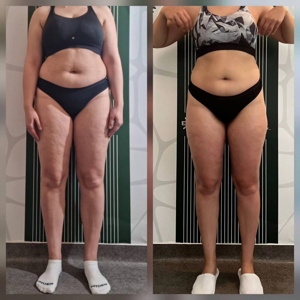 rezultate tratament celulita