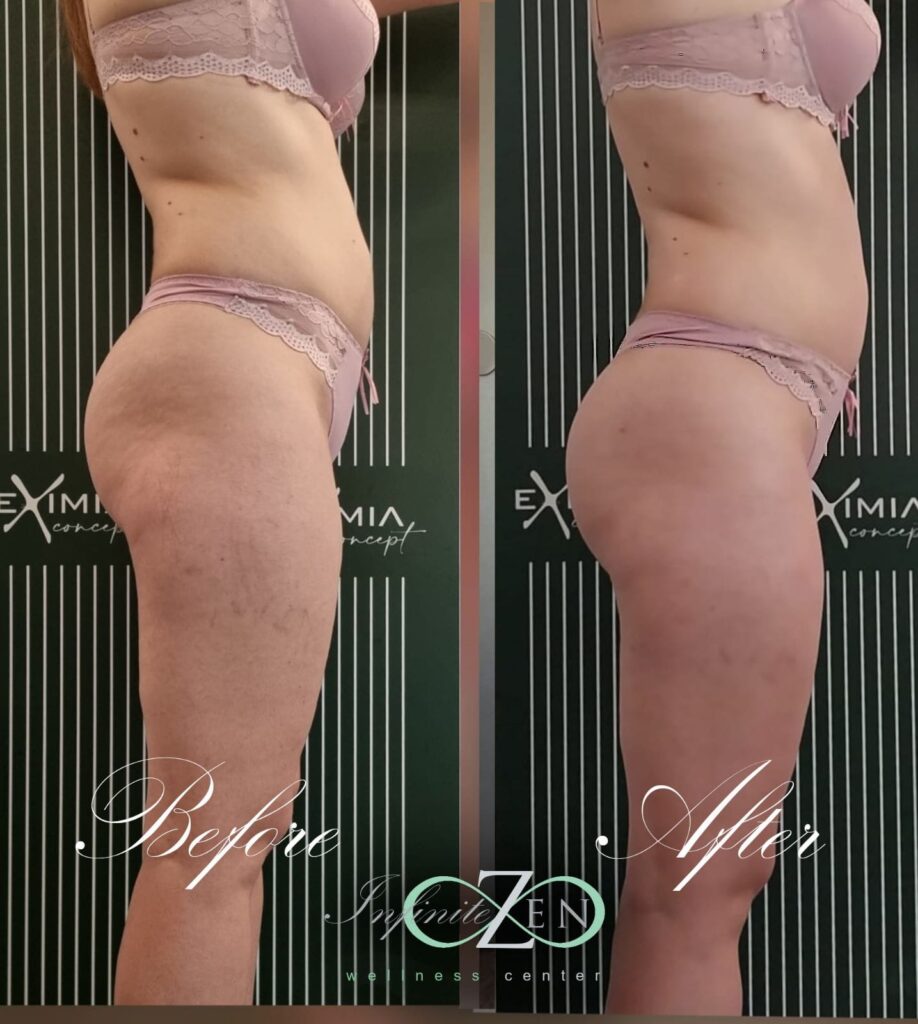 tratament anti celulita